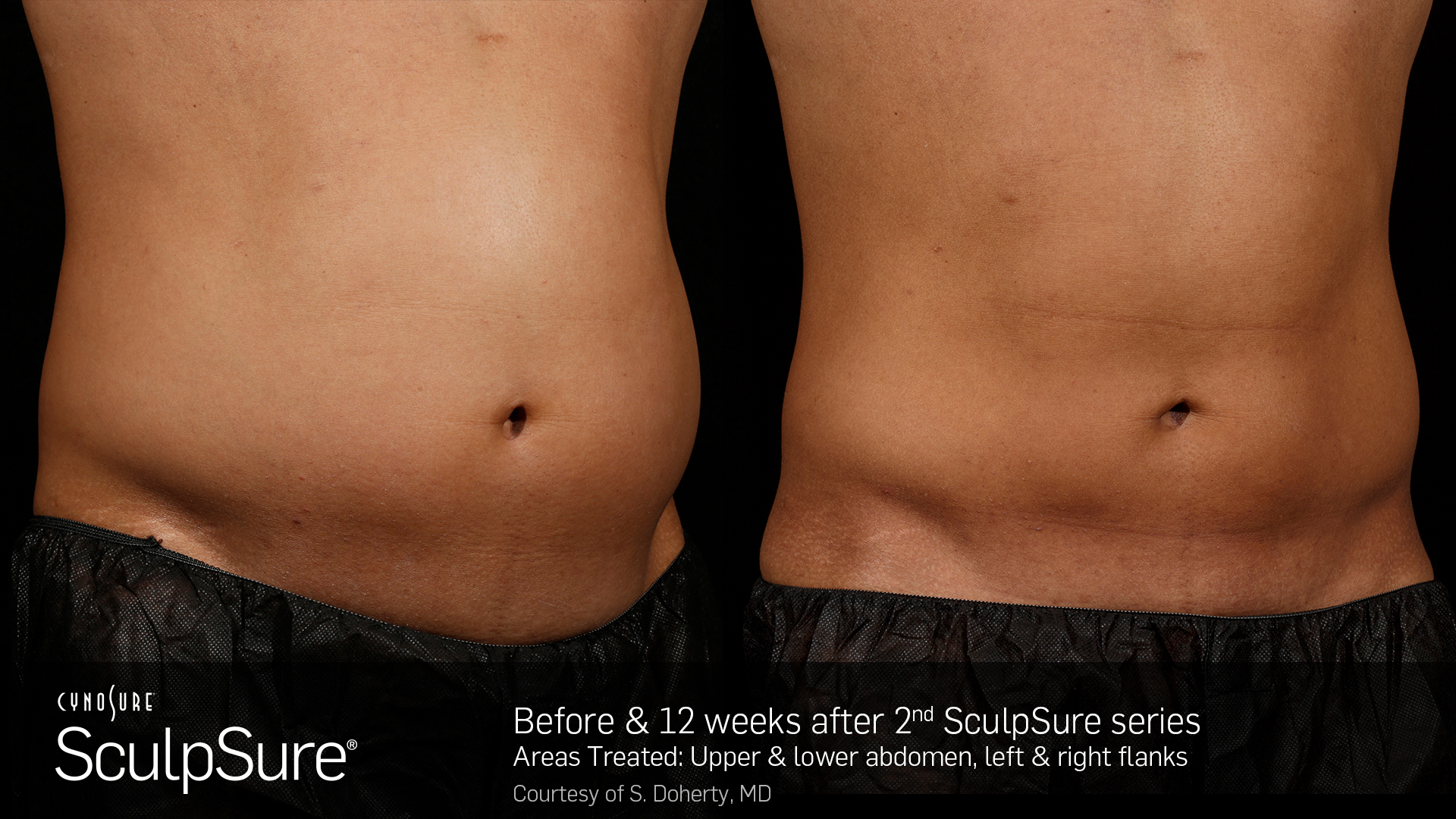 SculpSure Tuscaloosa, SculpSure Northport